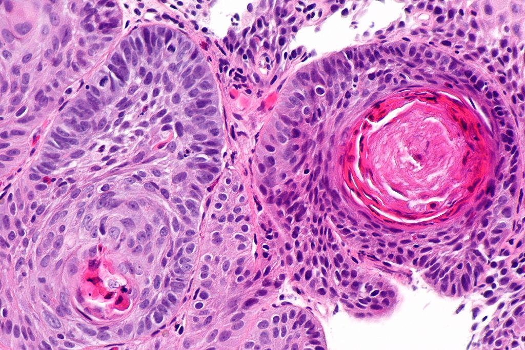 Esophogeal squamous cell carcinoma Creative Commons 3.0