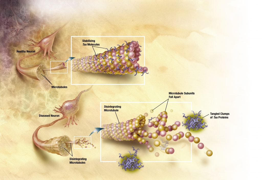 Tau proteins destroy microtubules of neurons https://commons.wikimedia.org/wiki/File:TANGLES_HIGH.jpg - Credit: ADEAR: "Alzheimer's Disease Education and Referral Center, a service of the National Institute on Aging."