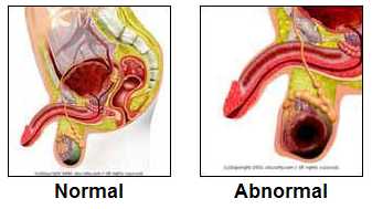 Figure 3. Compare and contrast of Cancerous and normal Testicle. (Creative Commons)