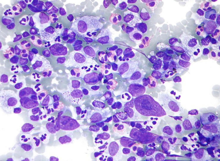 Figure 1. Mixture of cells common in HL ( Creative commons Author: SA 3.0)